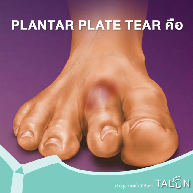 PLANTAR PLATE TEAR คือ