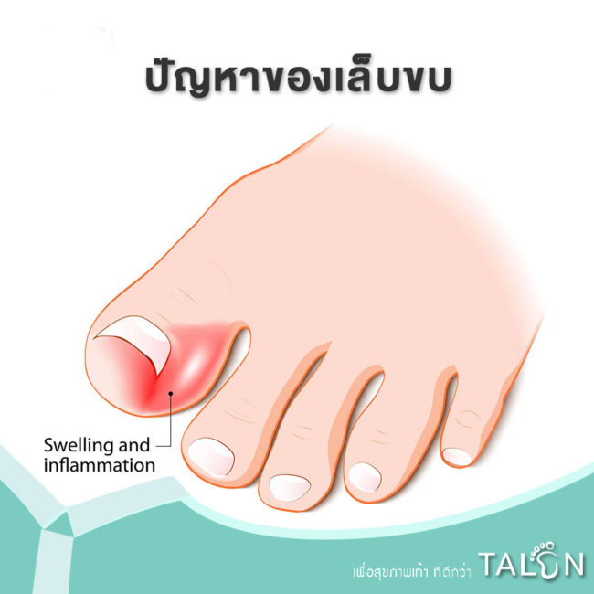 ปัญหาของเล็บขบ