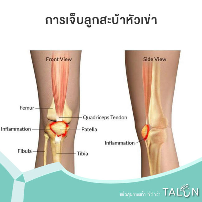 การเจ็บลูกสะบ้าหัวเข่า การเจ็บลูกสะบ้าหัวเข่า